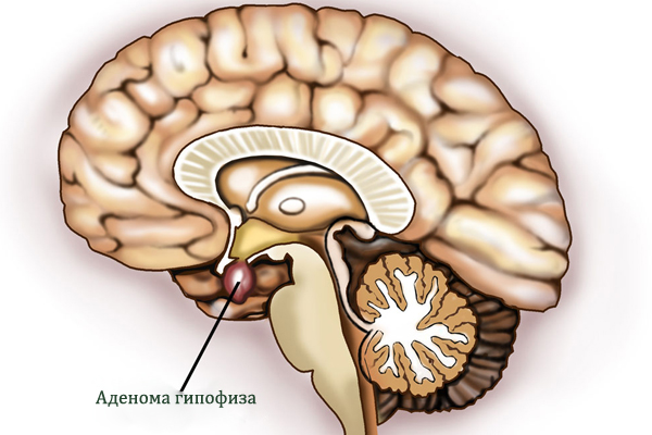 Опасна ли микроаденома гипофиза?