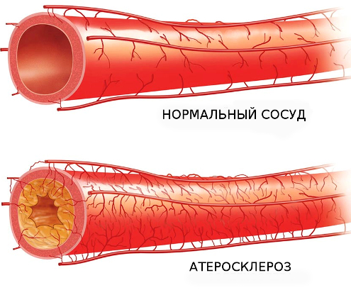 Атеросклероз