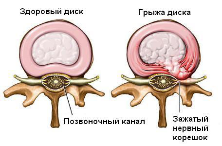 Грыжа диска