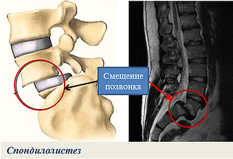 Спондилолистез